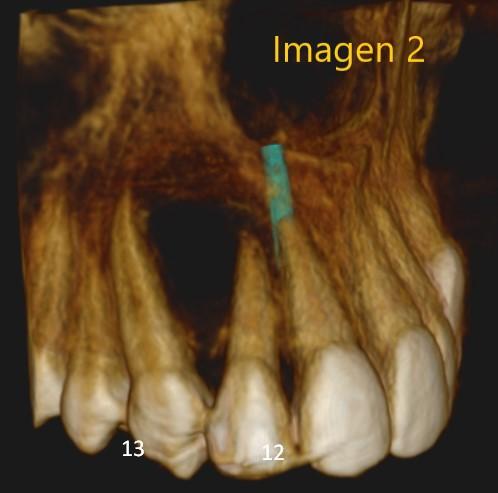 https://www.radiodontica.com.ar/blog/casos-radiograficos-3/caso-ndeg-64-quiste-radicular-70